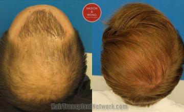 Hair restoration procedure before and after pictures