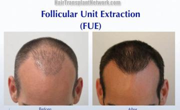 Hair transplantation surgery before and after photos