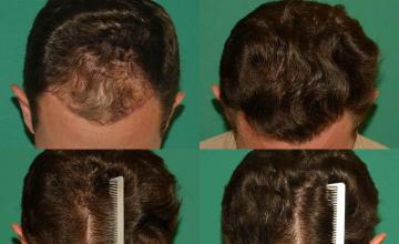 Hair restoration procedure before and after results