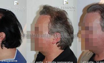 Hair transplantation surgery before and after pictures