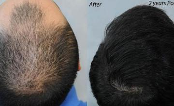 Hair transplantation surgery before and after photos