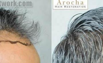 Hair transplantation surgery before and after photos