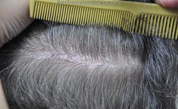 Hair restoration surgery before and after photos