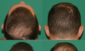 Hair transplantation surgery before and after photos