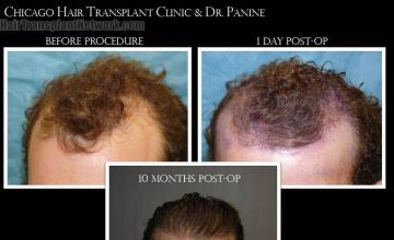 Before and after hair transplantation result photographs