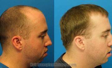 Hair transplantation surgery before and after photos