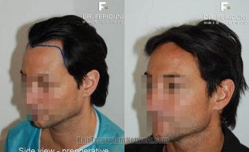 Hair transplantation surgery before and after pictures