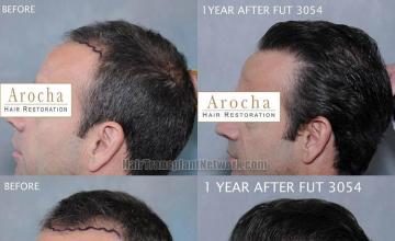 Hair transplantation surgery before and after pictures