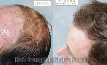 Hair transplantation surgery before and after pictures