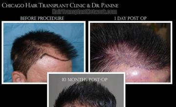 Hair transplantation surgery before and after images