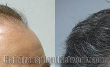 Hair transplantation surgery before and after images