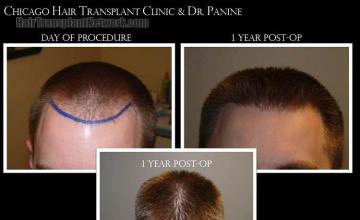 Top view - Before and after surgical hair replacement