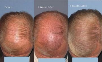 Hair restoration procedure before and after pictures