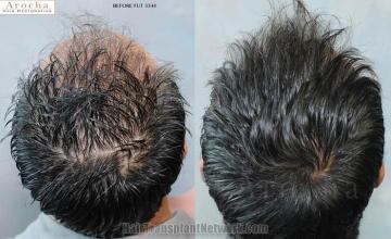 Hair restoration procedure before and after pictures