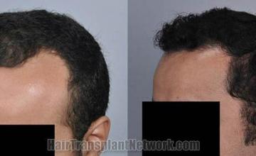 Hair restoration procedure before and after pictures