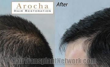 Hair transplantation surgery before and after images