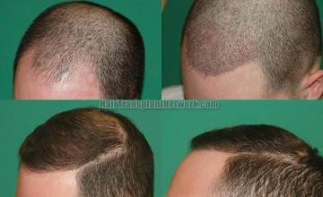 Hair transplantation surgery before and after pictures