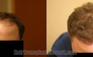 Hair transplantation surgery before and after photos