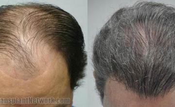 Hair transplantation surgery before and after photos