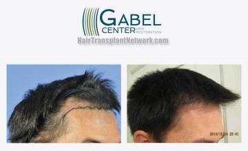 Hair restoration procedure before and after results