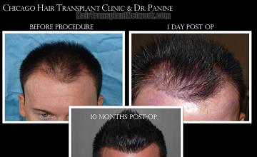 Hair restoration procedure before and after results