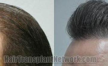 Hair transplantation surgery before and after pictures