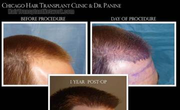 Hair transplantation surgery before and after pictures