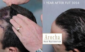 Hair transplantation surgery before and after photos