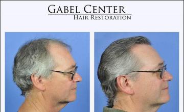 Hair restoration procedure before and after results