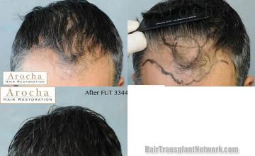 Hair restoration procedure before and after results