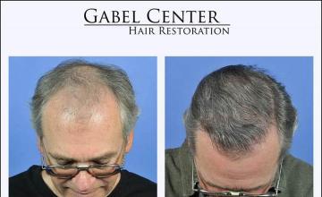 Top view - Before and after surgical hair replacement