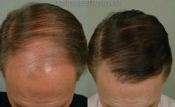 Hair transplantation surgery before and after photos