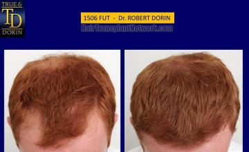 Hair restoration procedure before and after pictures