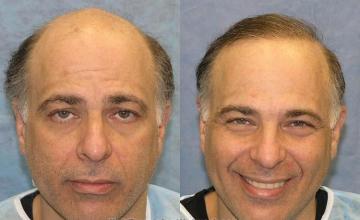  before and after pictures