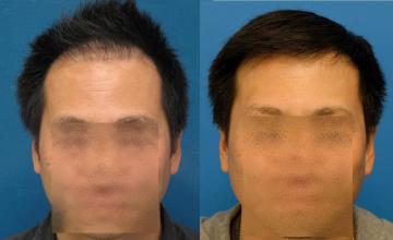 Hair restoration procedure before and after results