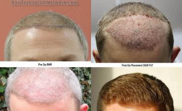 Hair restoration procedure before and after results