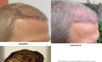 Hair transplantation surgery before and after images