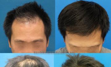 Hair transplantation surgery before and after photos