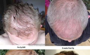 Hair transplantation surgery before and after photos