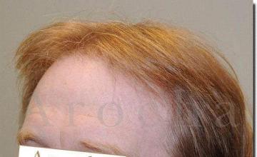 Hair restoration procedure results