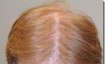 Hair restoration procedure results