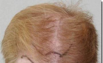 Hair restoration procedure results