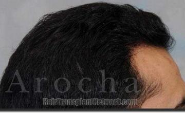 Hair restoration procedure results