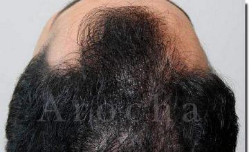 Hair restoration procedure results