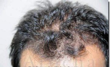 Hair restoration procedure results