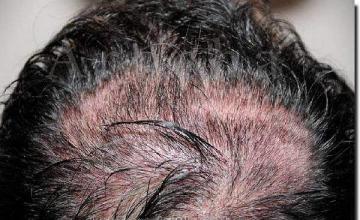 Hair restoration procedure results