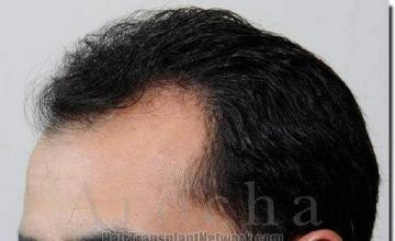 Hair restoration procedure results