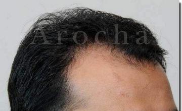 Hair restoration procedure results