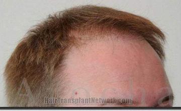 Hair restoration procedure results