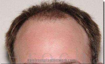 Hair restoration procedure results